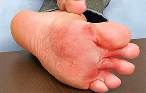 Athlete’s Foot or Tinea Pedis